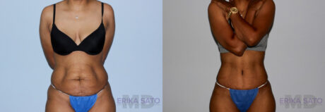 Tummy Tuck case #7093