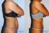 Tummy Tuck case #7093 slider thumbnail