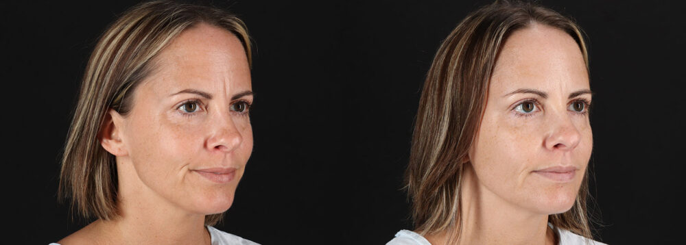 Botox® & Other Neuromodulators case #5064