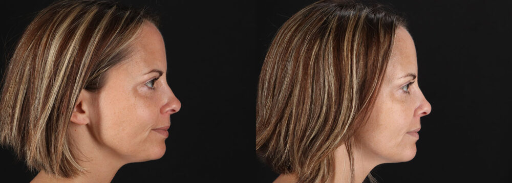 Botox® & Other Neuromodulators case #5064