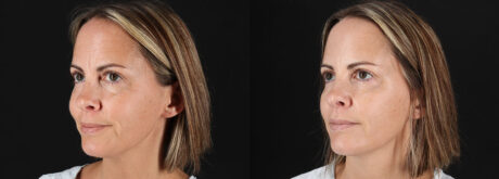 Botox® & Other Neuromodulators case #5064