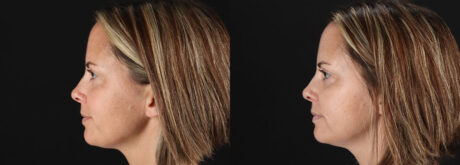 Botox® & Other Neuromodulators case #5064