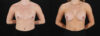 Breast Augmentation case #6478 slider thumbnail