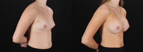 Breast Augmentation case #6478