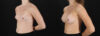 Breast Augmentation case #6478 slider thumbnail