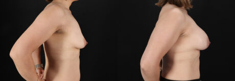 Breast Augmentation case #6472