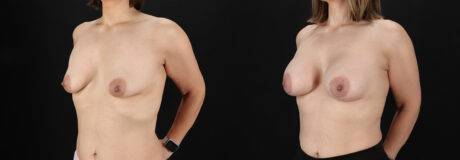 Breast Augmentation case #6472