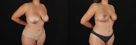 Breast Lift case #7820