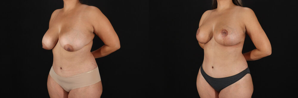 Breast Lift case #7820