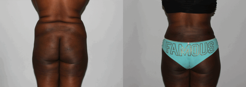 Brazilian Butt Lift case #4471