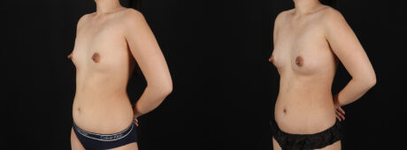 Fat Grafting to the Breast case #256223