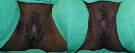 Labiaplasty case #5798