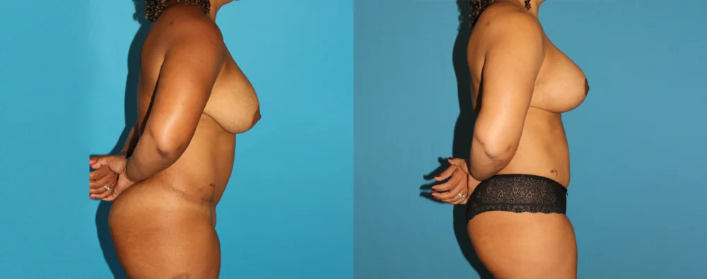 Mommy Makeover case #6507