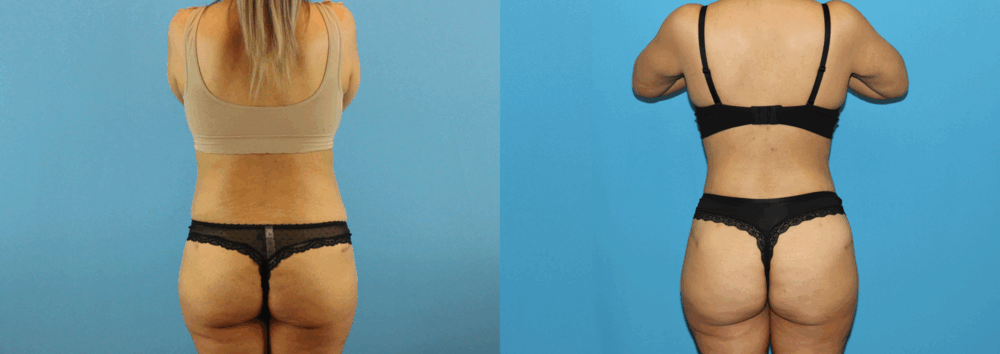 Brazilian Butt Lift case #4881