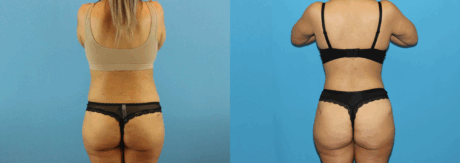 Brazilian Butt Lift case #4881