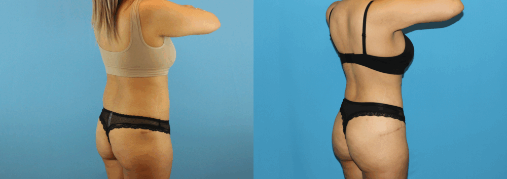 Brazilian Butt Lift case #4881