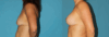 Breast Lift with Implants case #7872 slider thumbnail