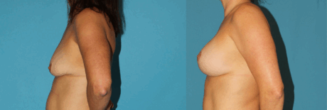Breast Lift with Implants case #7872