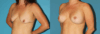 Breast Lift with Implants case #7872 slider thumbnail