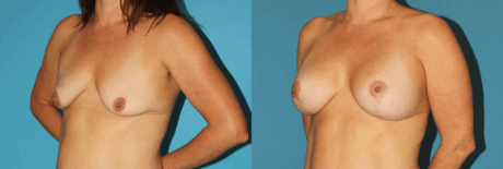 Breast Lift with Implants case #7872