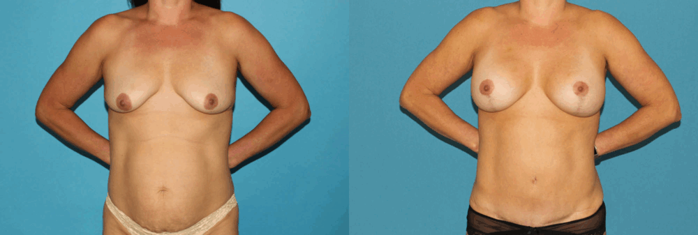 Breast Lift with Implants case #7872