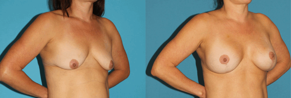 Breast Lift with Implants case #7872