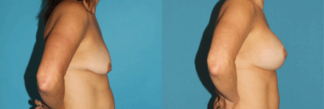 Breast Lift with Implants case #7872
