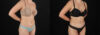 Liposuction case #6236 slider thumbnail