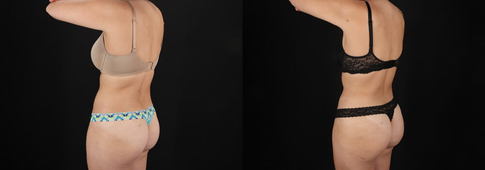 Liposuction case #6236