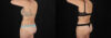 Liposuction case #6236 slider thumbnail