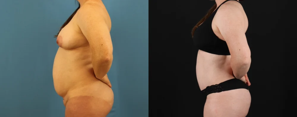 Mommy Makeover case #6514