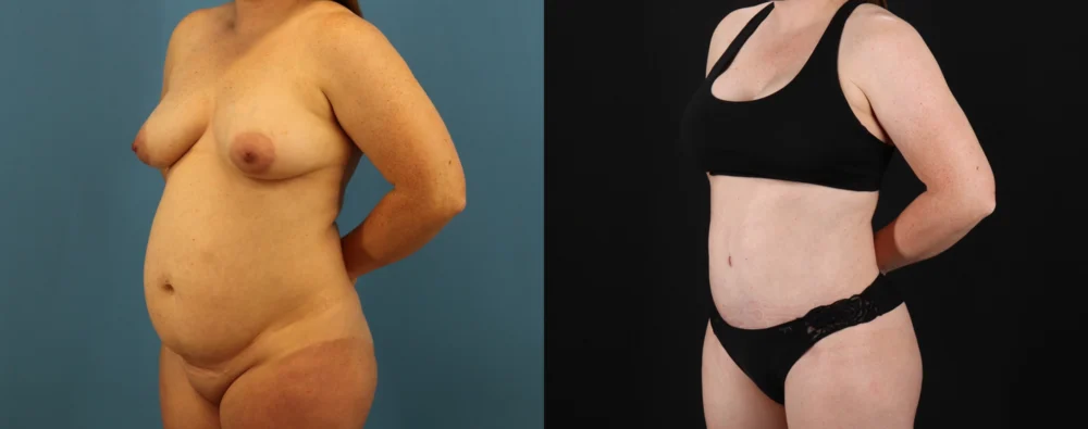 Mommy Makeover case #6514