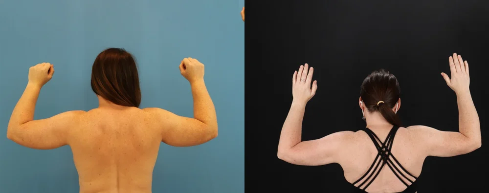 Mommy Makeover case #6514