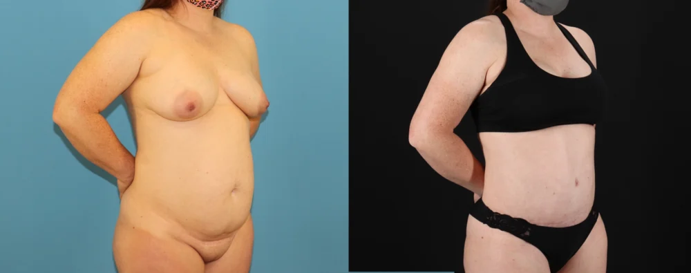 Mommy Makeover case #6514