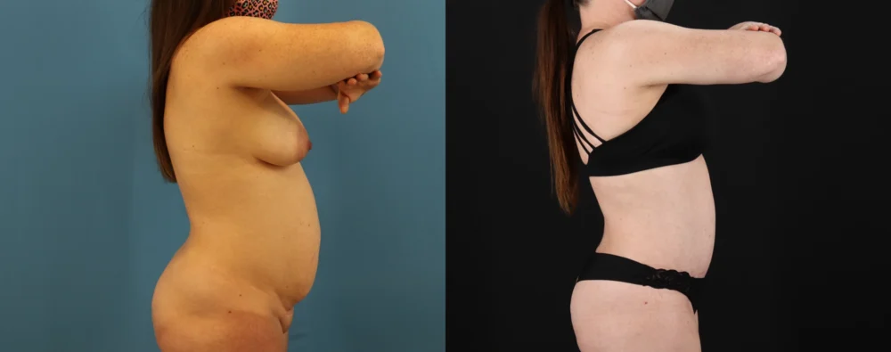 Mommy Makeover case #6514