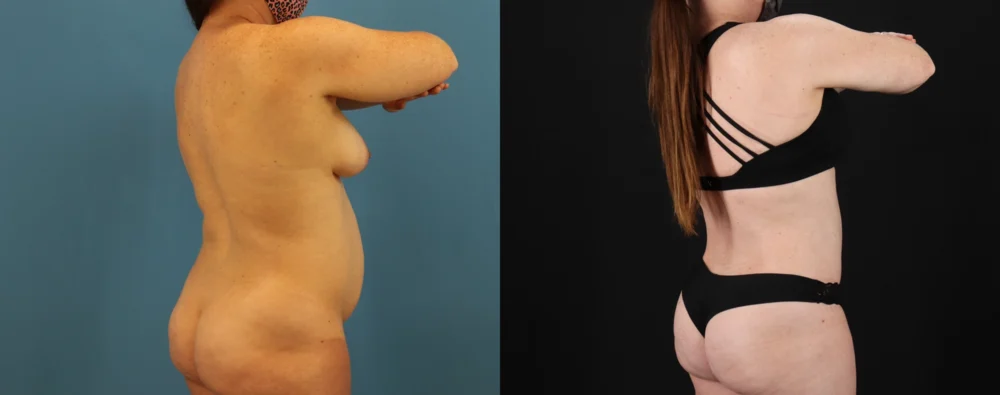 Mommy Makeover case #6514