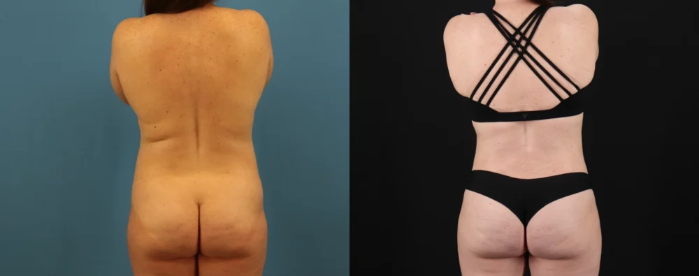 Mommy Makeover case #6514