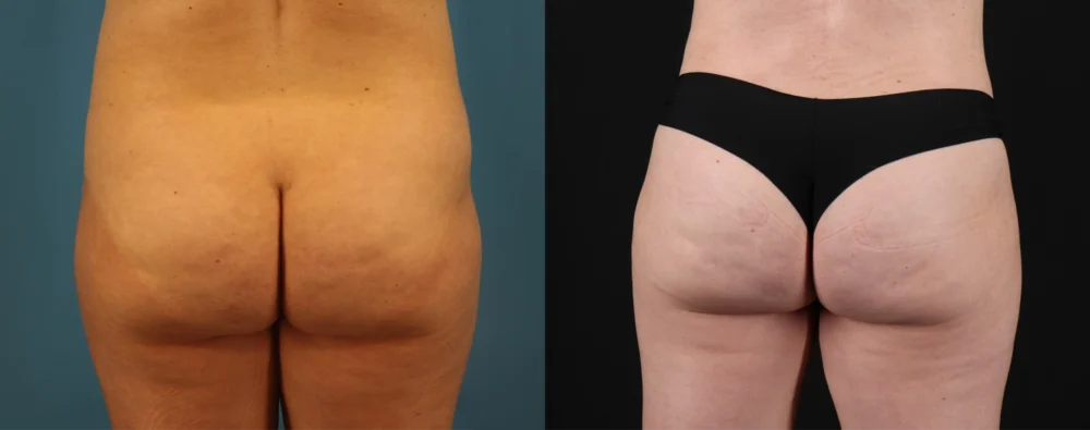 Mommy Makeover case #6514