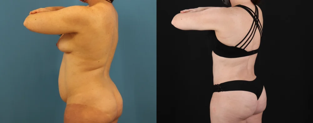 Mommy Makeover case #6514