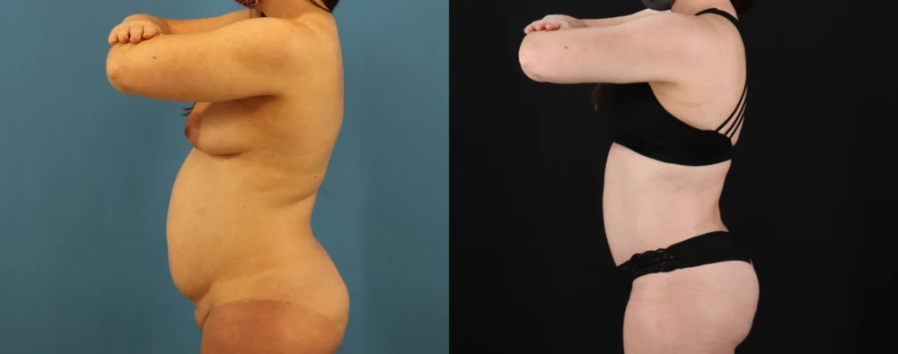 Mommy Makeover case #6514