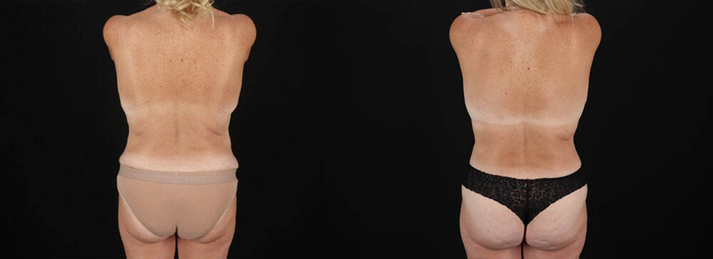 Post Bariatric Surgery (Massive Weight Loss) case #6784