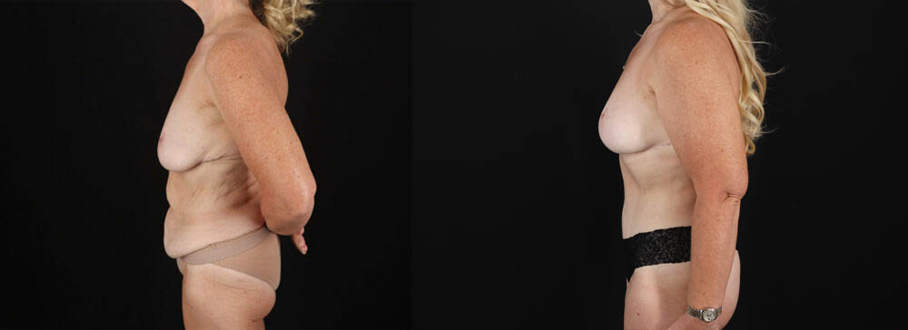 Post Bariatric Surgery (Massive Weight Loss) case #6784