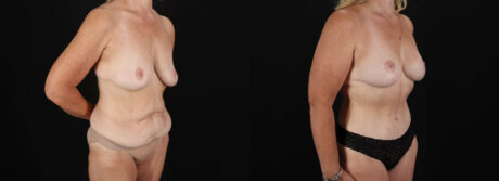 Post Bariatric Surgery (Massive Weight Loss) case #6784