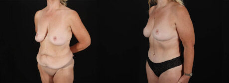 Post Bariatric Surgery (Massive Weight Loss) case #6784