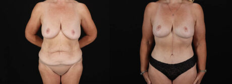 Post Bariatric Surgery (Massive Weight Loss) case #6784