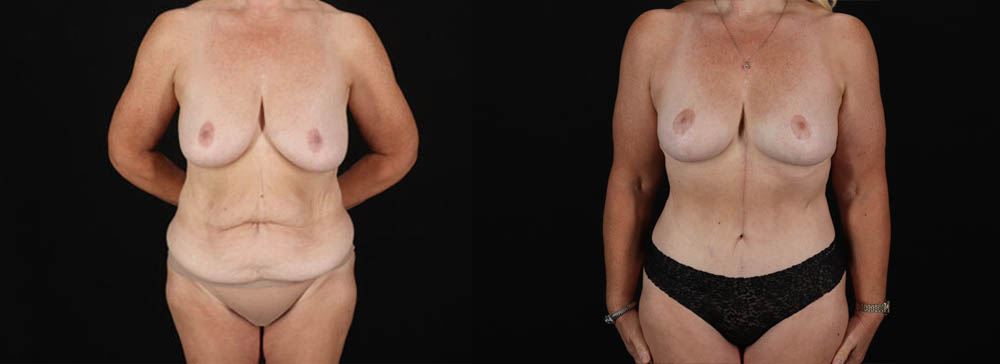 Post Bariatric Surgery (Massive Weight Loss) case #6784