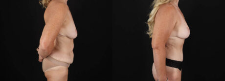 Post Bariatric Surgery (Massive Weight Loss) case #6784