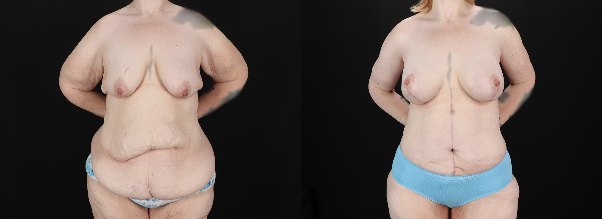 Massive-Weight-Loss-Before-and-After-Photo-by-Dr.-Erika-A.-Sato-in-Houston-TX-258476-1