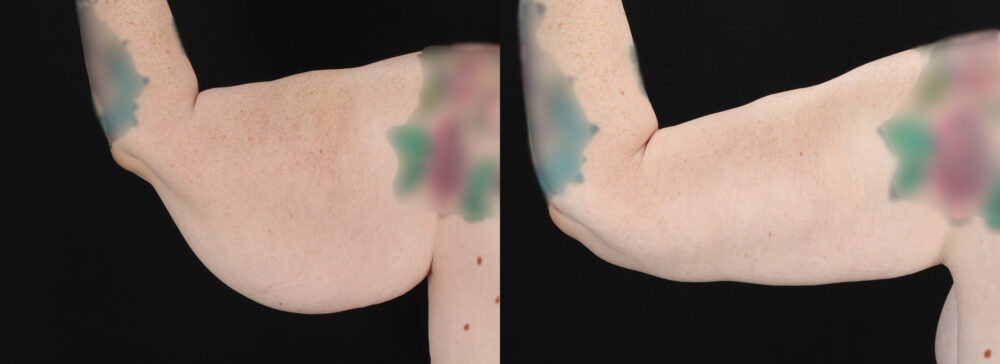 Post Bariatric Surgery (Massive Weight Loss) case #6786