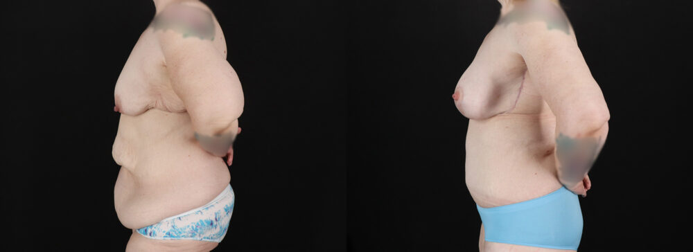 Post Bariatric Surgery (Massive Weight Loss) case #6786